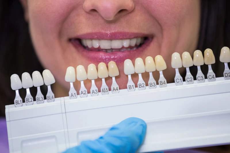همه چیز در مورد کامپوزیت دندان - رنگ‌های کامپوزیت دندان